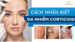 Da bị nhiễm corticoid