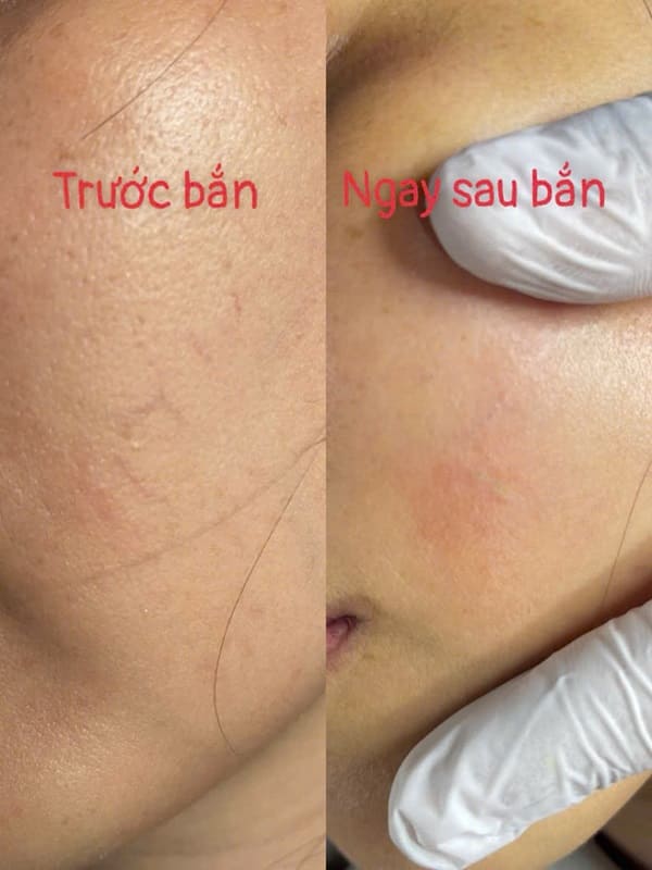 Máy Diode Laser 980nm