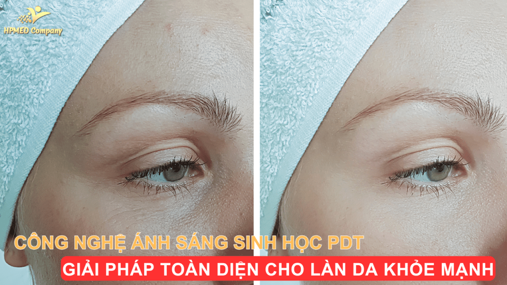Máy vòm ánh sánh sinh học Medilux PDT LED