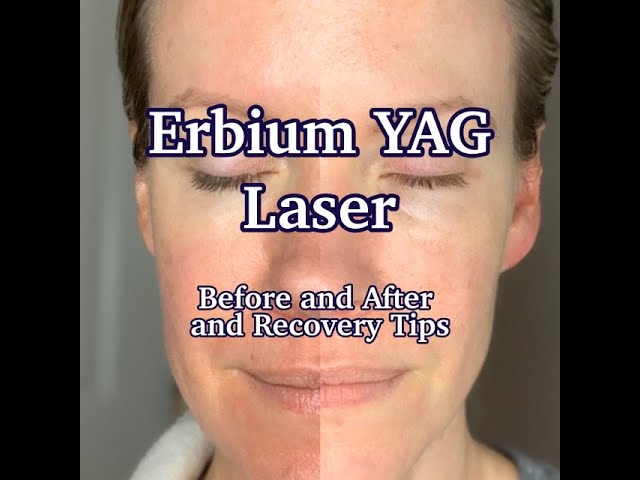 erbium laser la gi nguyen ly hoat dong va 8 ung dung pho bien cua erbium laser 67973d6c2e7c9