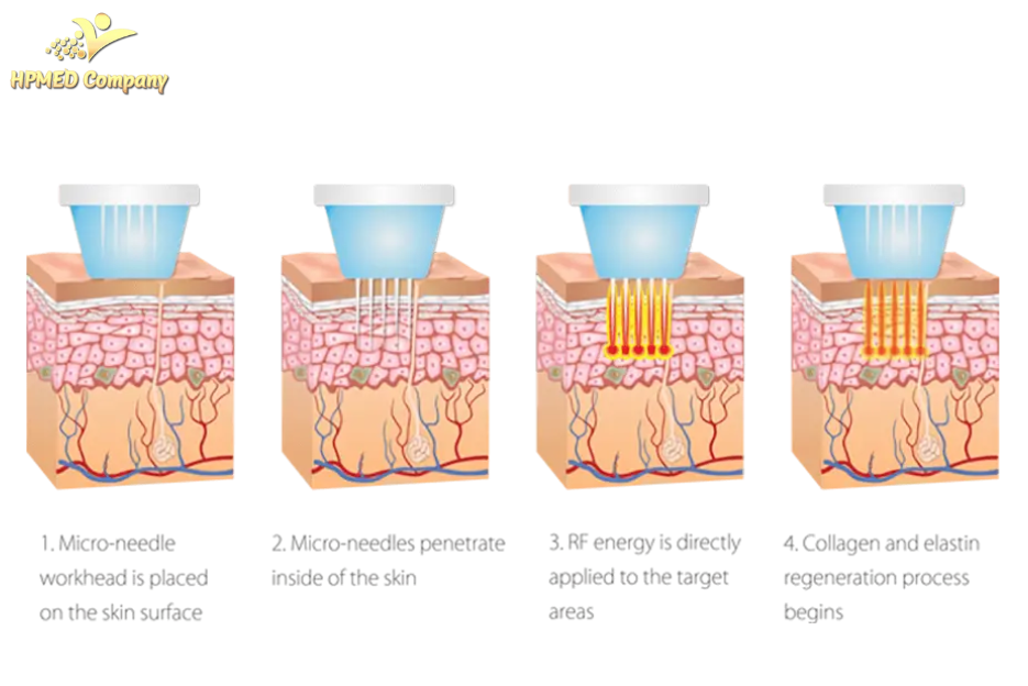Công nghệ RF (Radio Frequency) Fractional