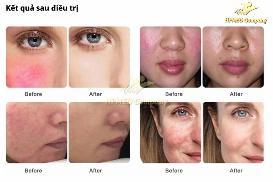 Máy Điều Trị Giãn Mao Mạch 