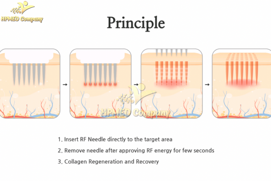 Nguyên Lý Hoạt Động Máy RF Vi Điểm