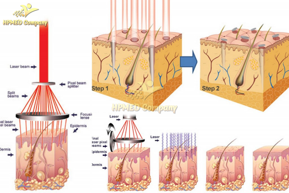 Nguyên Lý Hoạt Động Máy Laser Co2 Fractional