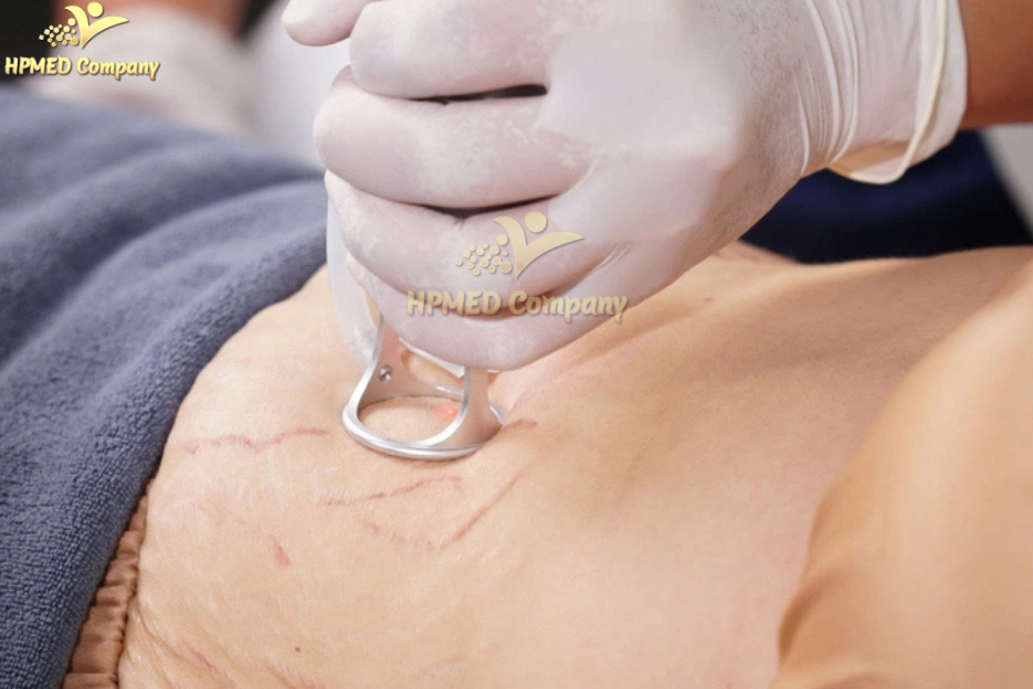 Trị rạn da bằng máy laser co2 fractional