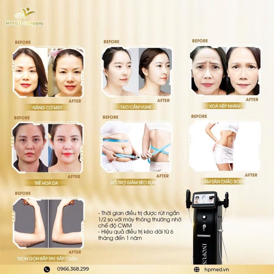 Máy HIFU Nâng Cơ Inofus Cao Cấp Hàn Quốc