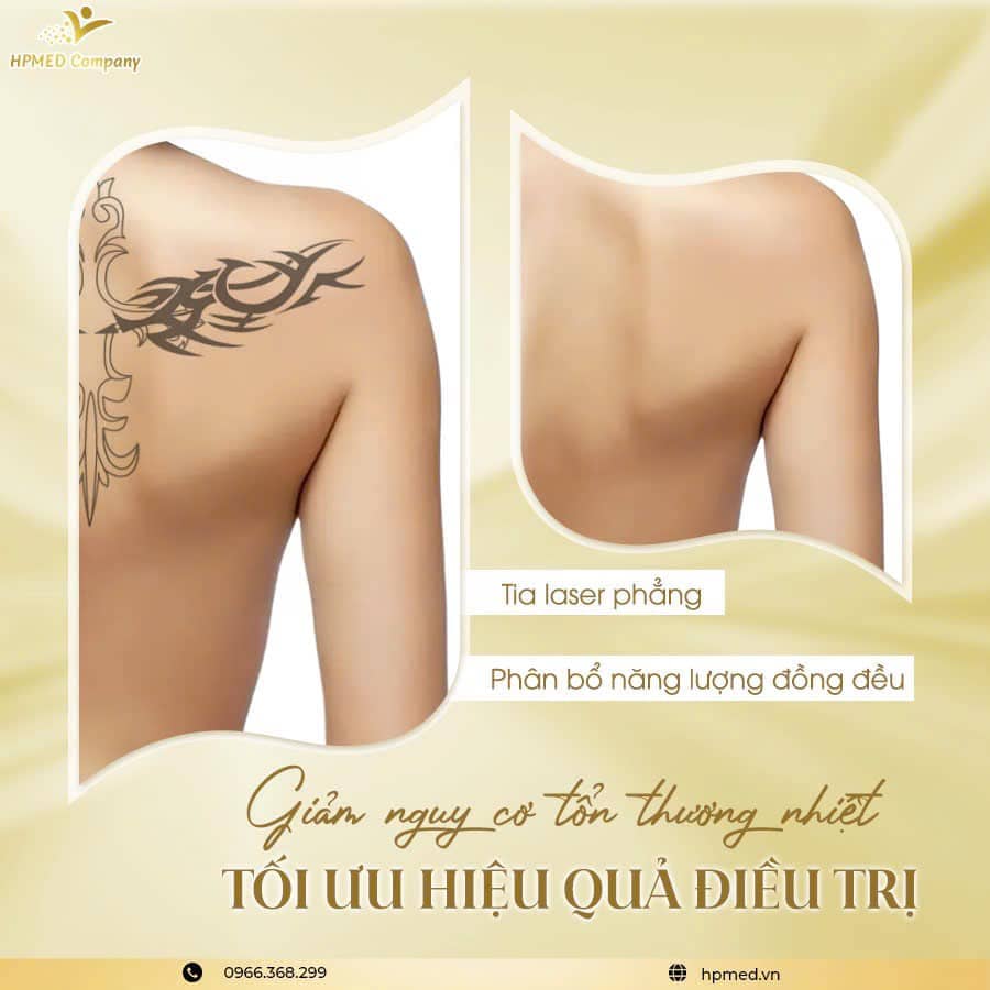 Máy Laser Pico Ultra 360 Bilen Thượng Hải