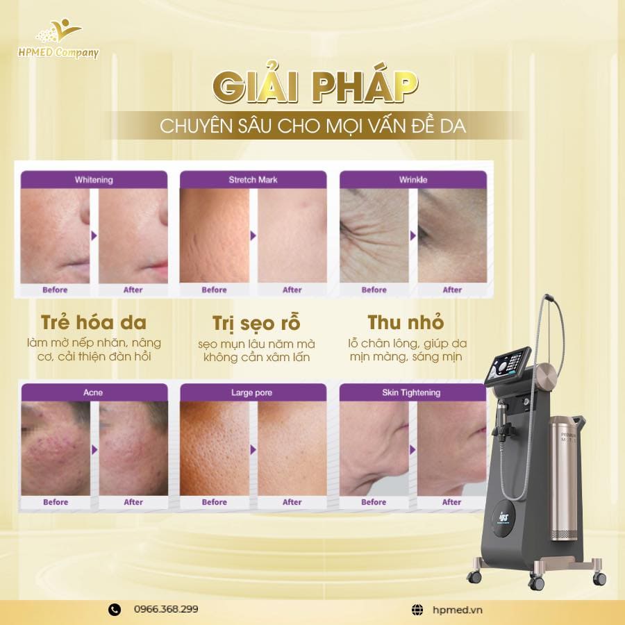 Máy Rf Vi Điểm Pinacle IDS Hàn Quốc