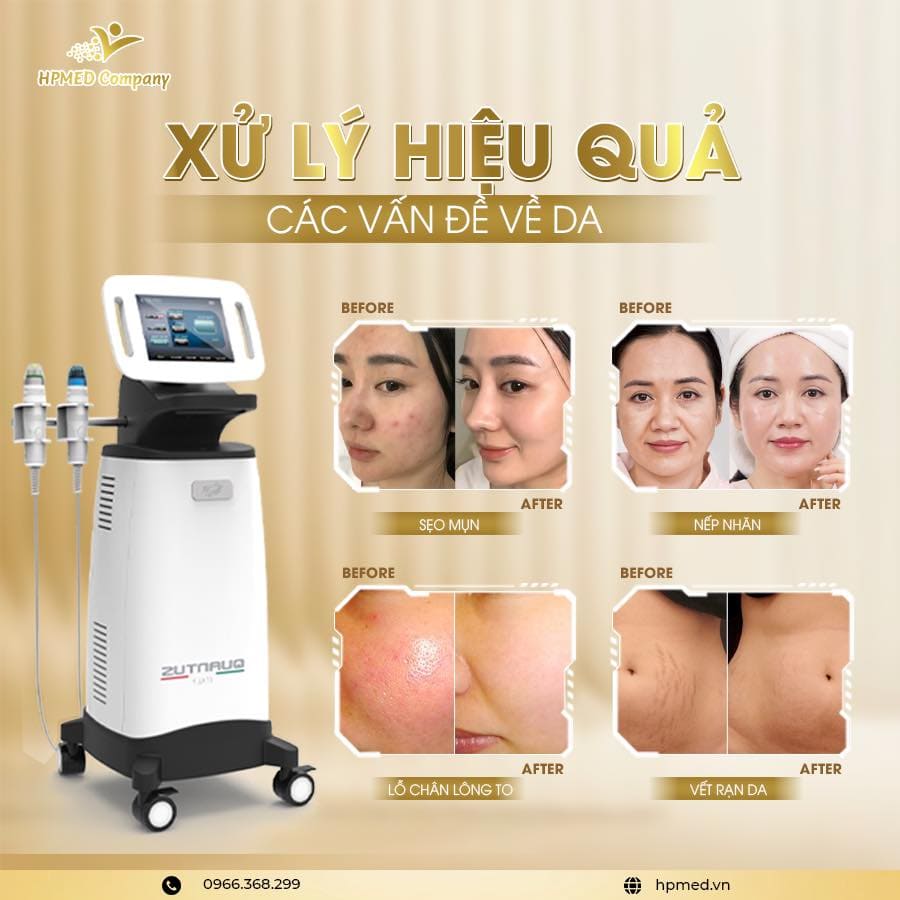 Máy Rf Vi Điêm Quantus Bắc Kinh