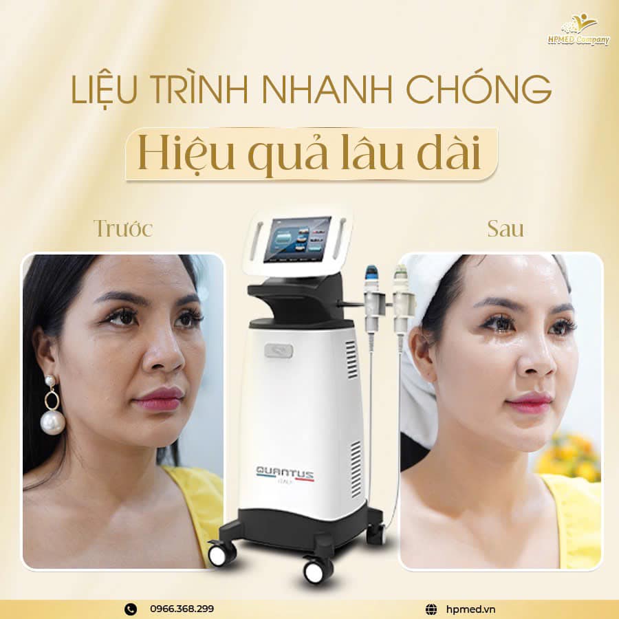 Máy Rf Vi Điểm Quantus Bắc Kinh