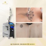 Máy Laser ND YAG Q-Switch SL-NY 602 Xóa Xăm Trị Nám