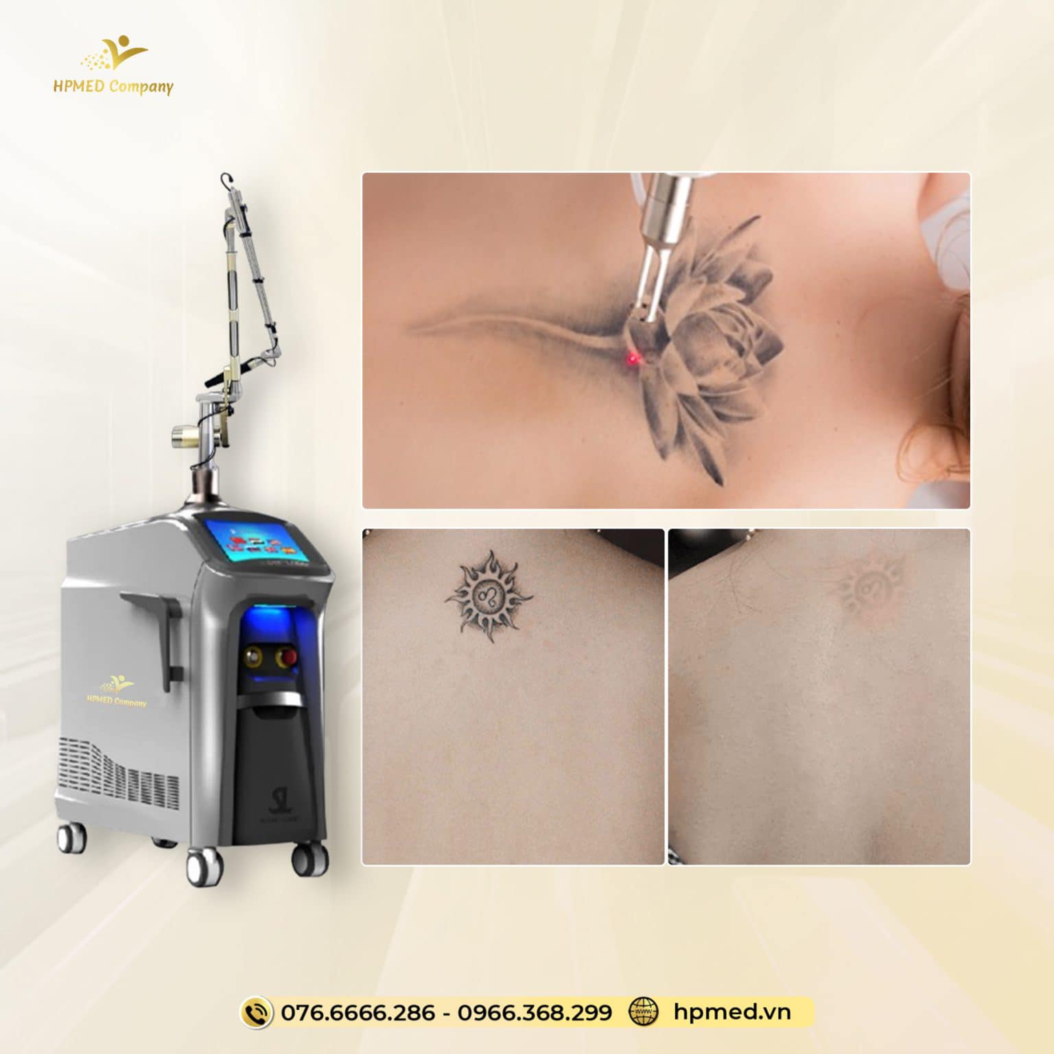 Máy Laser ND YAG Q-Switch SL-NY 602 Xóa Xăm Trị Nám