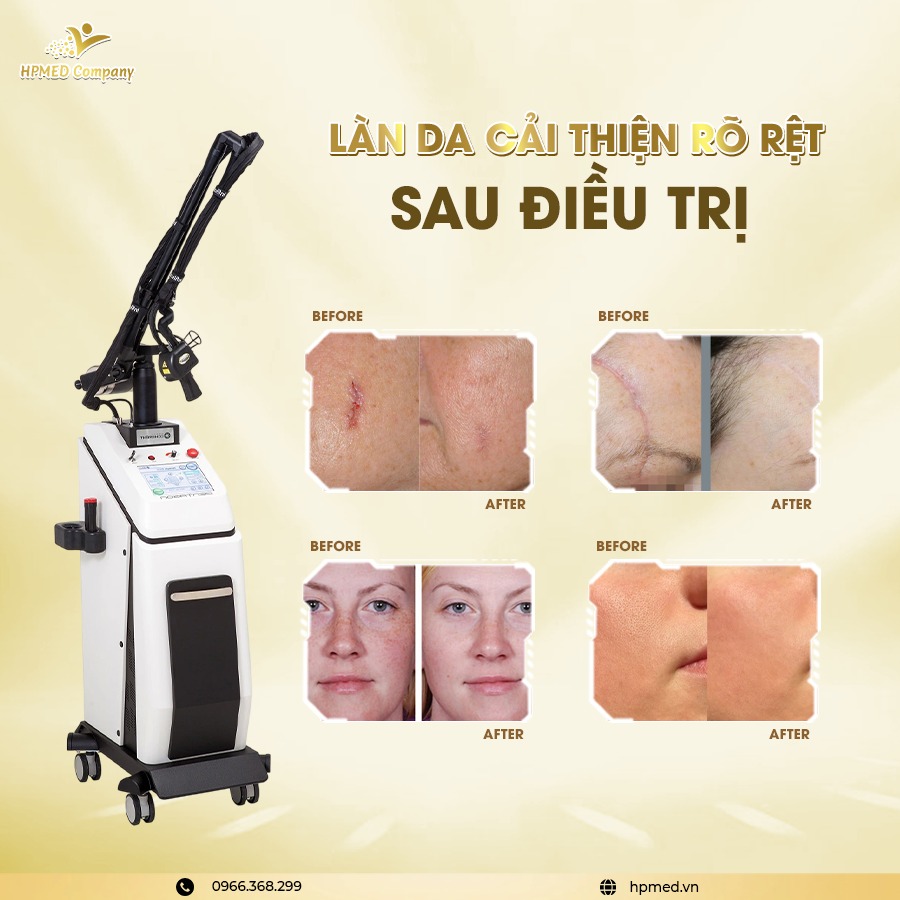 Máy Laser CO2 Fractional Pentagon GRAND Bóng Hợp Kim RF ⭐ Chuẩn Trị Sẹo & Tái Tạo Da Chuyên Sâu Hàn Quốc 4 Máy Laser CO2 Fractional Pentagon GRAND Bóng Hợp Kim RF ⭐ Chuẩn Trị Sẹo & Tái Tạo Da Chuyên Sâu Hàn Quốc